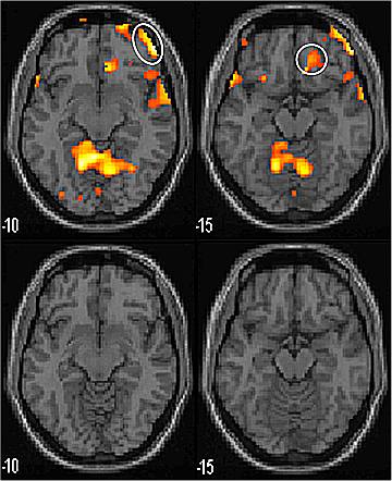 Imagerie par résonance magnétique fonctionnelle : le cortex préfrontal et le cortex cingulaire antérieur sont activés dans le groupe moxibustion après distension à 100 ml de l'ampoule rectale. 